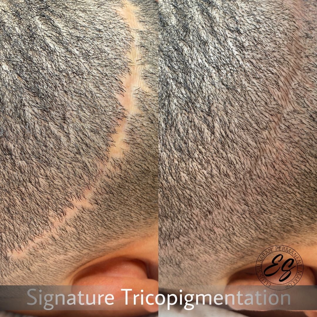 Tricopigmentacion