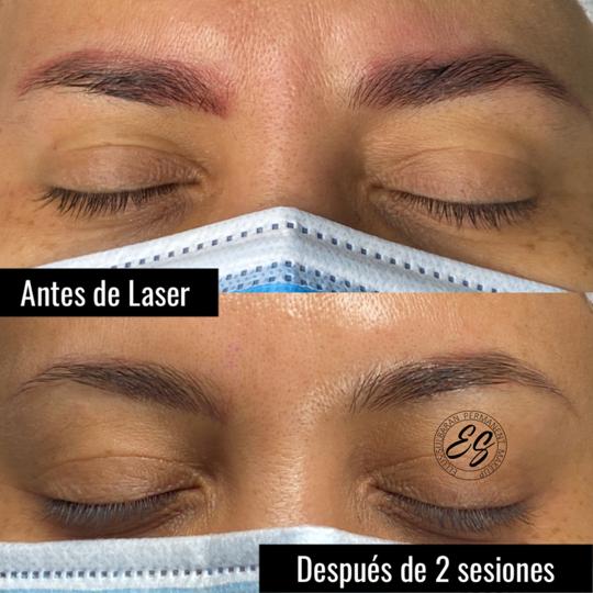 REMOCION MANUAL