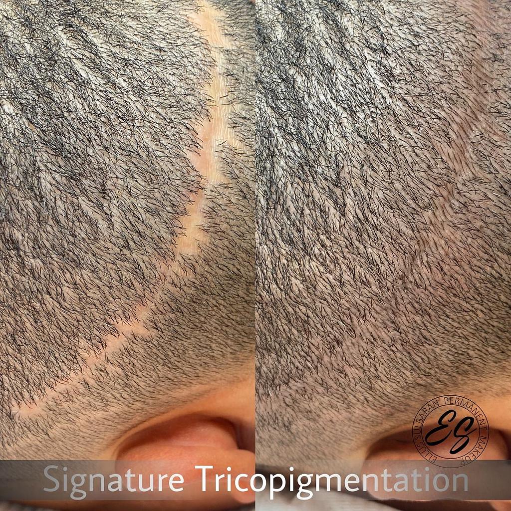 Tricopigmentacion