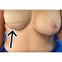 RECONSTRUCCION AREOLAR/ AREOLA TATTO