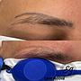 TATTO LASER REMOVAL/ REMOCION DE TATUAJES CON LASER