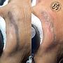 TATTO LASER REMOVAL/ REMOCION DE TATUAJES CON LASER
